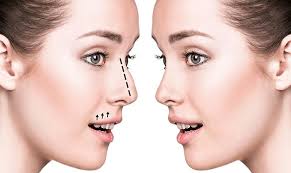 Is Nose Surgery in Dubai the Right Choice for Your Transformation